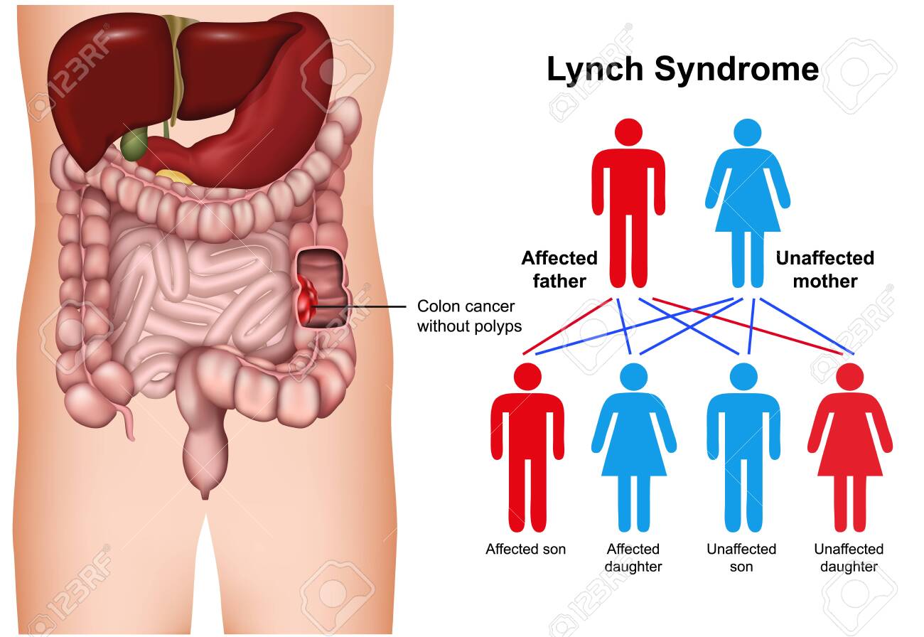 Lynch Syndrome Disease 3d Medical Vector Illustration On White