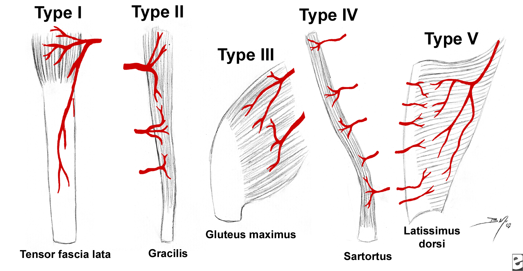Sartorius Muscle Flap
