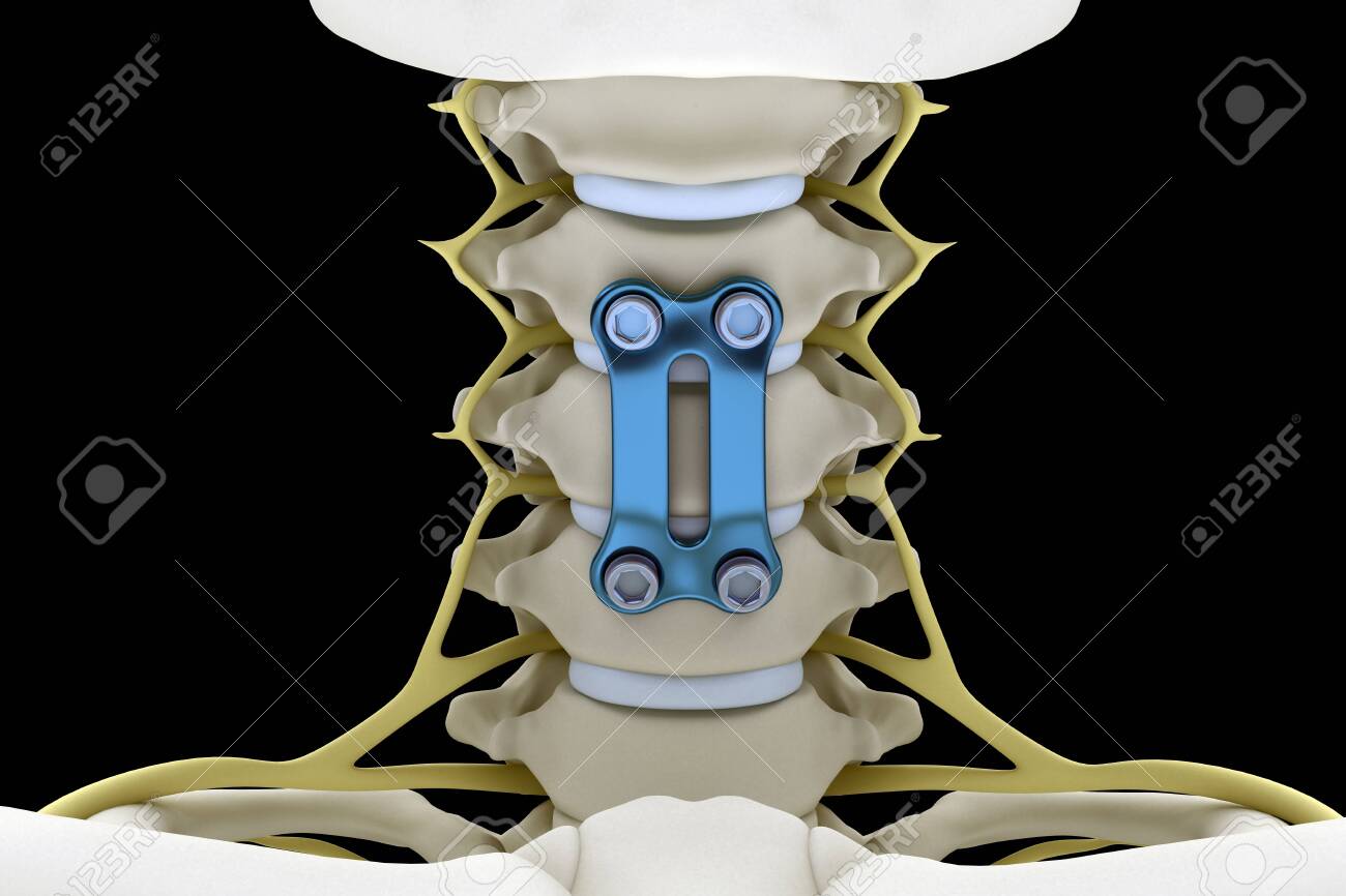 Cervical Vertebrae Fixed With A Metal Plate And Screws Isolated