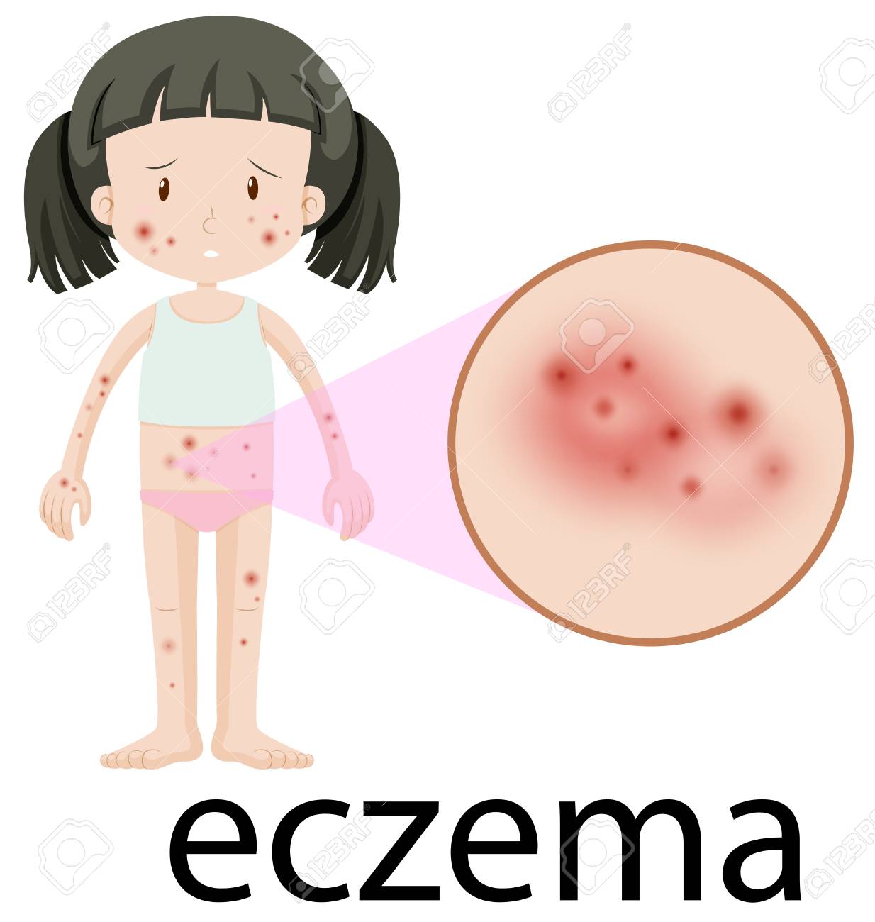 A Girl With Eczema On White Background Illustration Royalty
