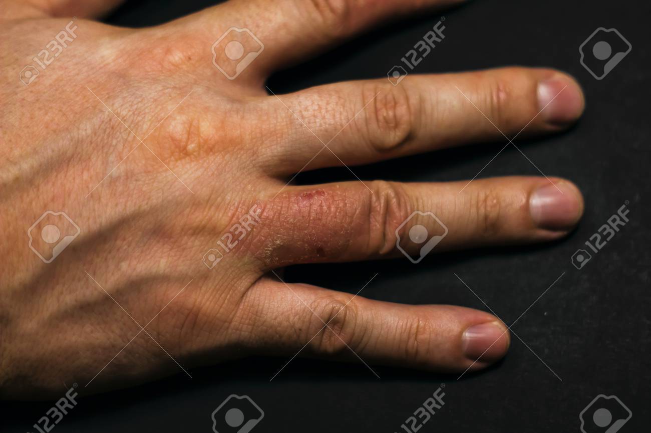 Hand Dermatitis Eczema Closed On Black Background Stock