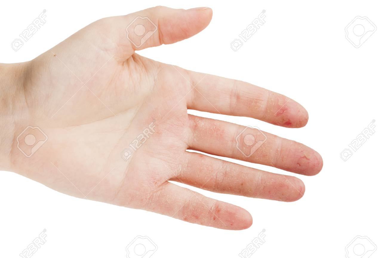 Female Hand With Dermatitis Or Eczema During An Exacerbation