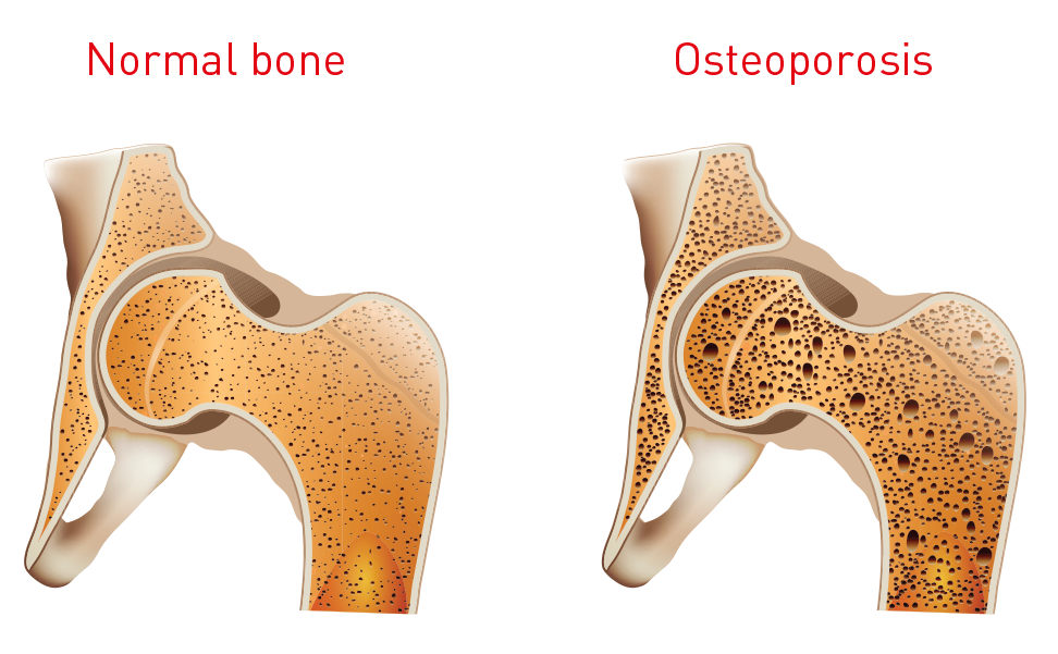 Osteoporosis Coffee And Health