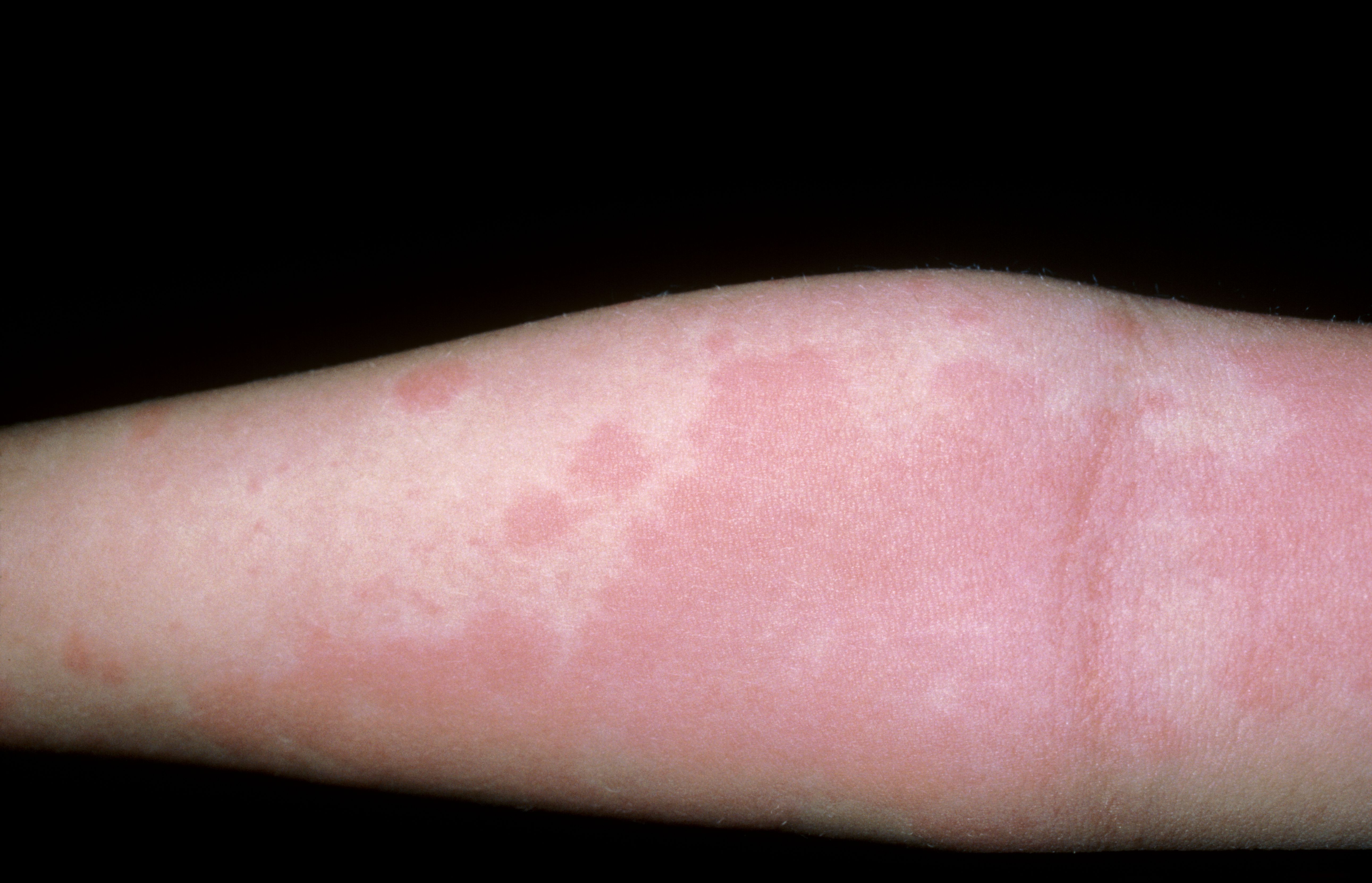 Best Rash Urticaria Medicine Dermatitis Health Itchy Allergy