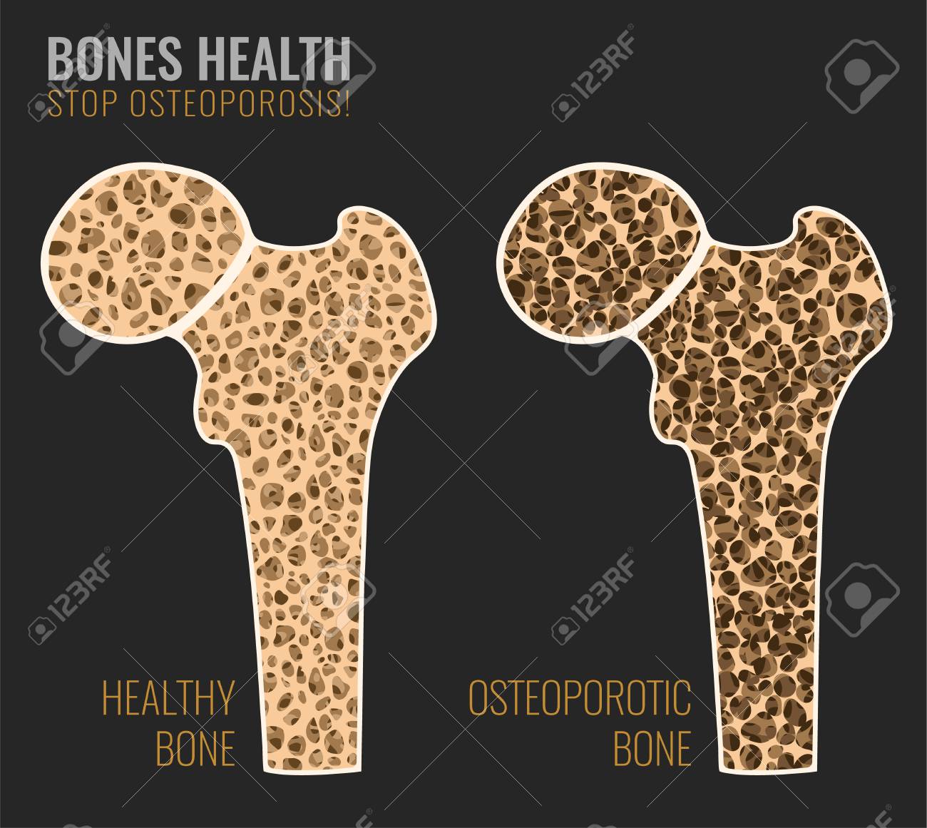 Illustration Of Osteoporosis Bone And Healthy In Parison
