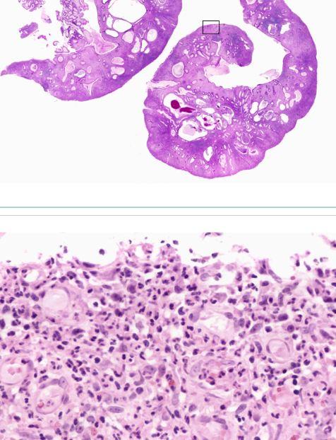 Sessile Polyp Juvenile Polyposis Studyblue Notes Note N