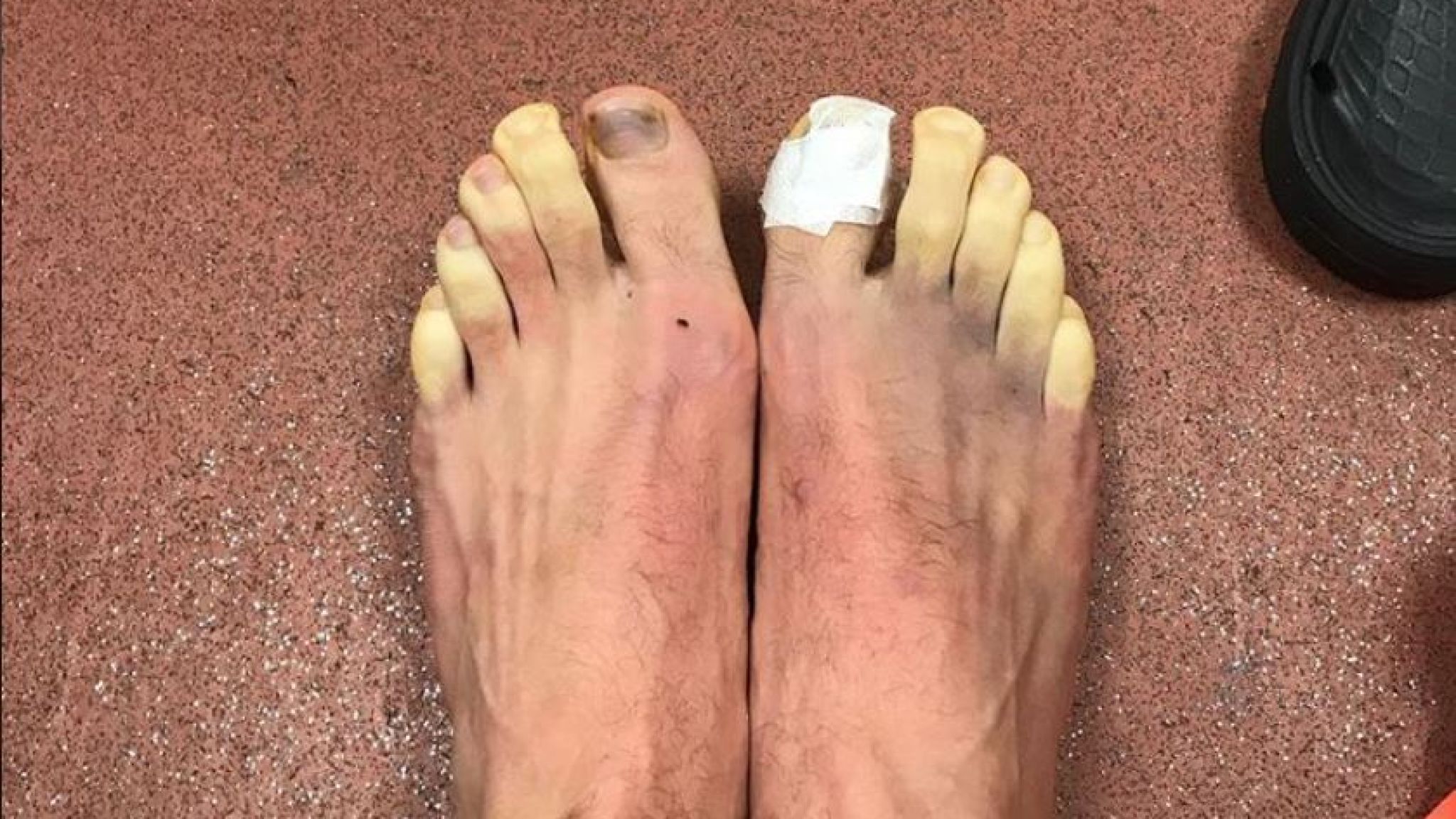Liverpool Star Adam Lallana S Toes Turn Yellow After Match On