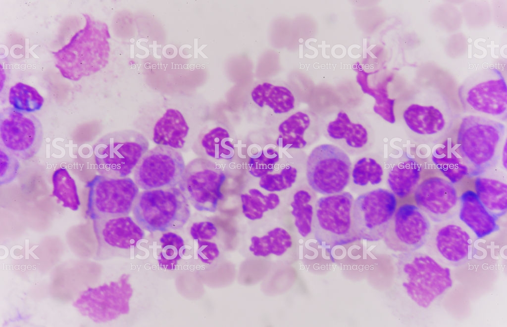 free-download-cancer-cell-in-human-showing-abnormal-cellsmedical