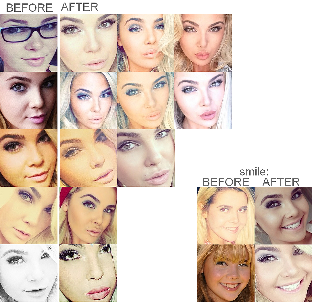 Destinee Monroe And Paris Imagens Botox Before