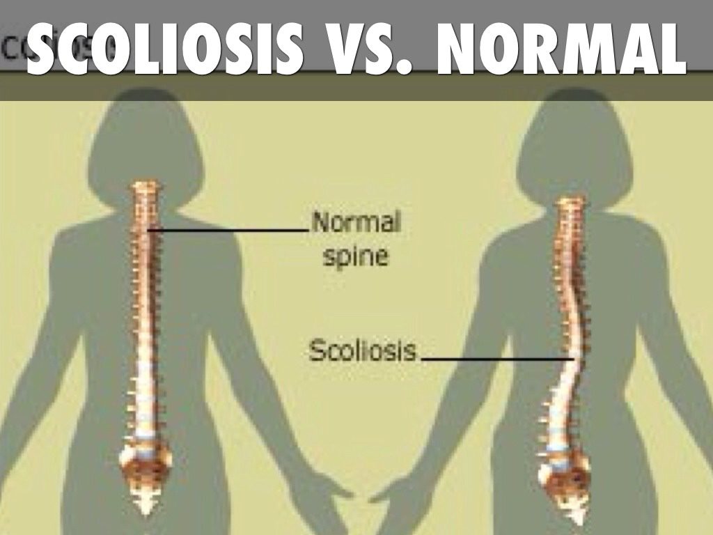 Invisible Illness Scoliosis