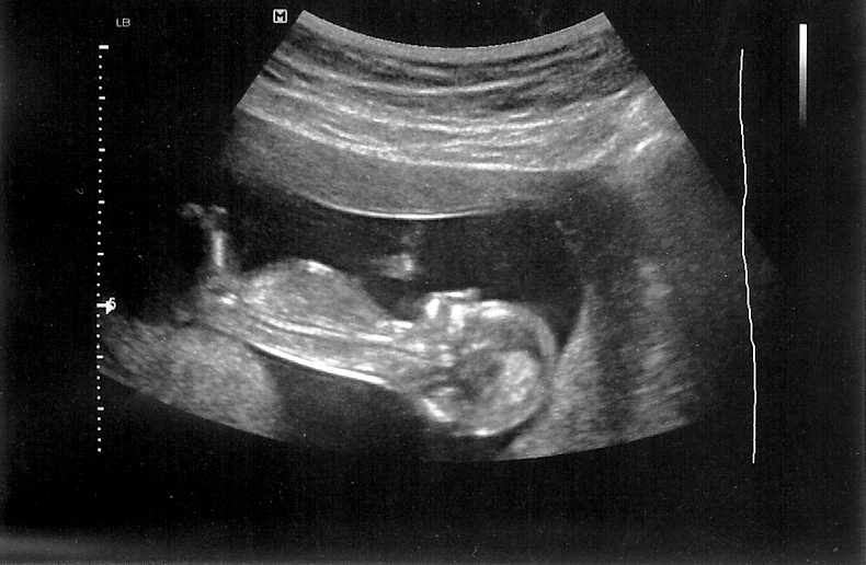 Source Url Mobile Wallpaper Fbistan Ultrasound Picture Of