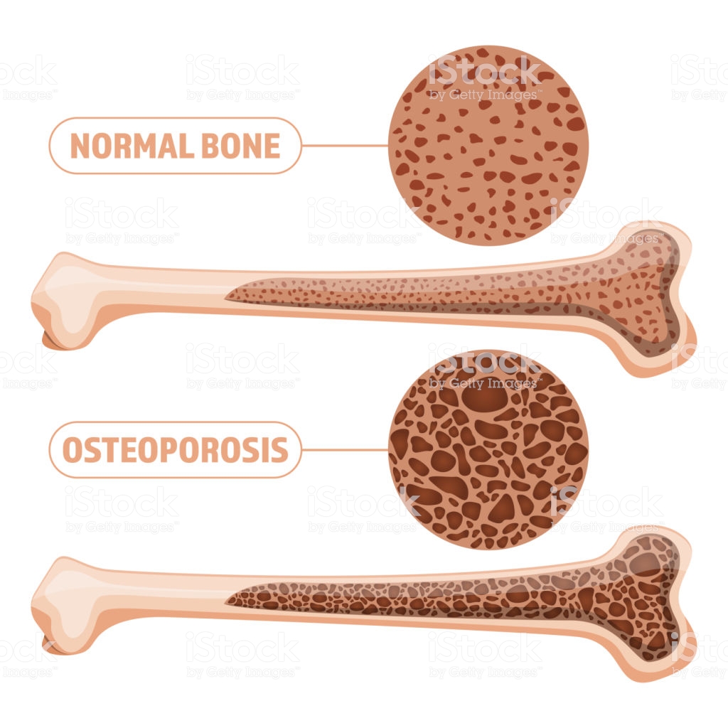 Osteoporosis Vector Design Illustration Isolated On White