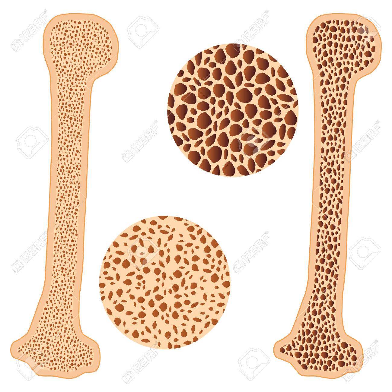 Illustration Of Osteoporosis Bone And Healthy On The White