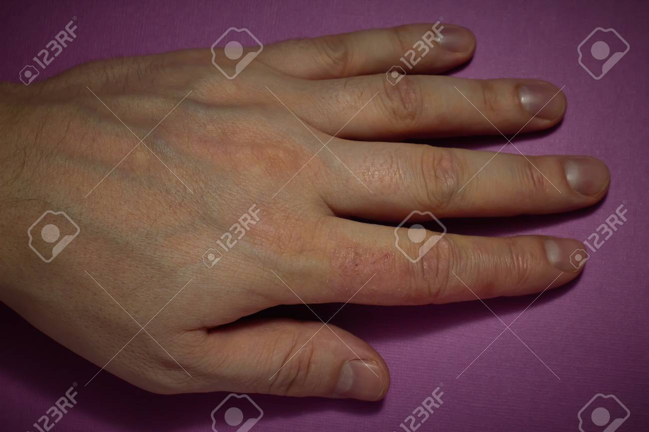 Hand Dermatitis Eczema Closed On Pink Background Stock Photo