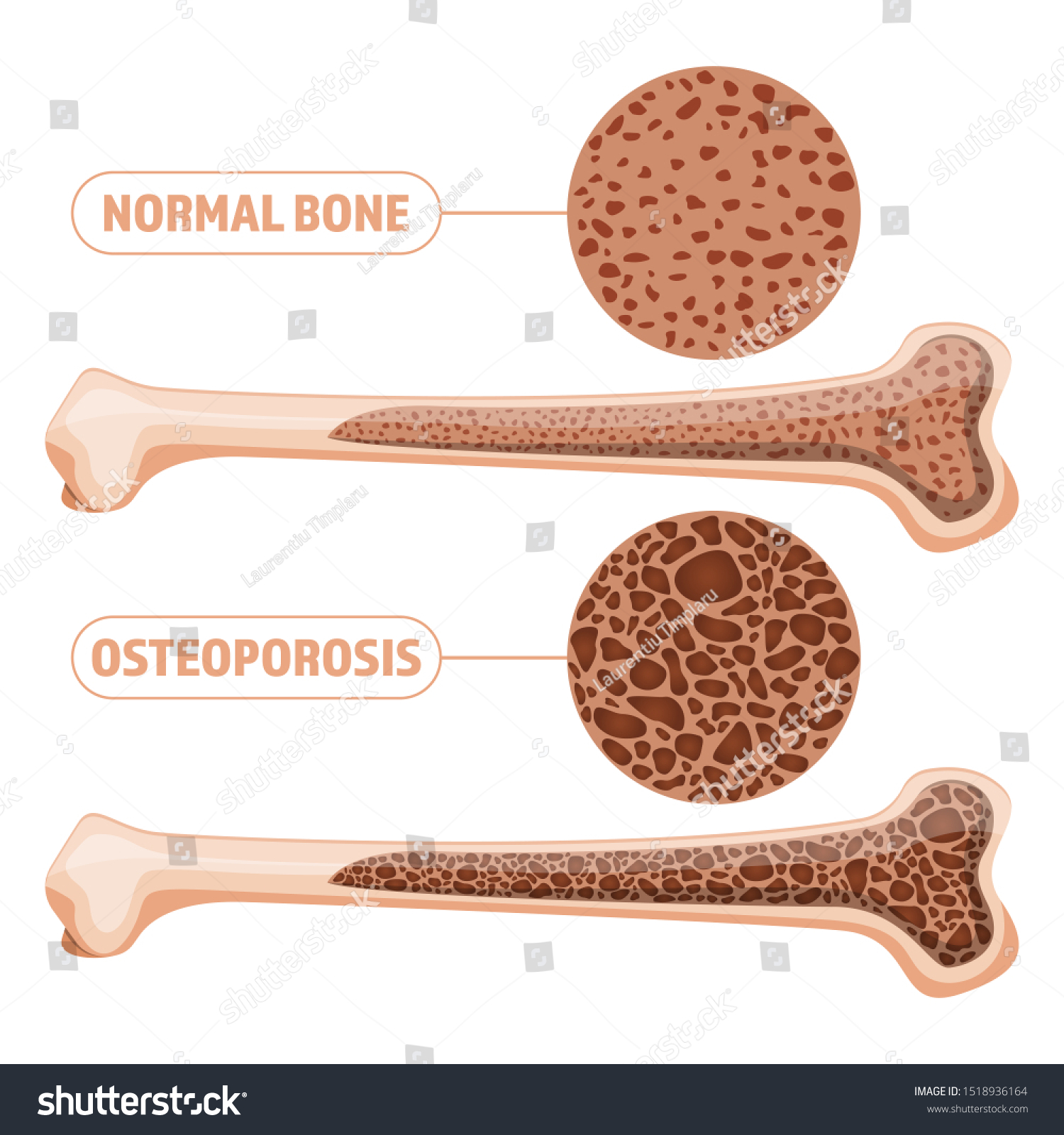 Osteoporosis Vector Design Illustration Isolated On The Arts