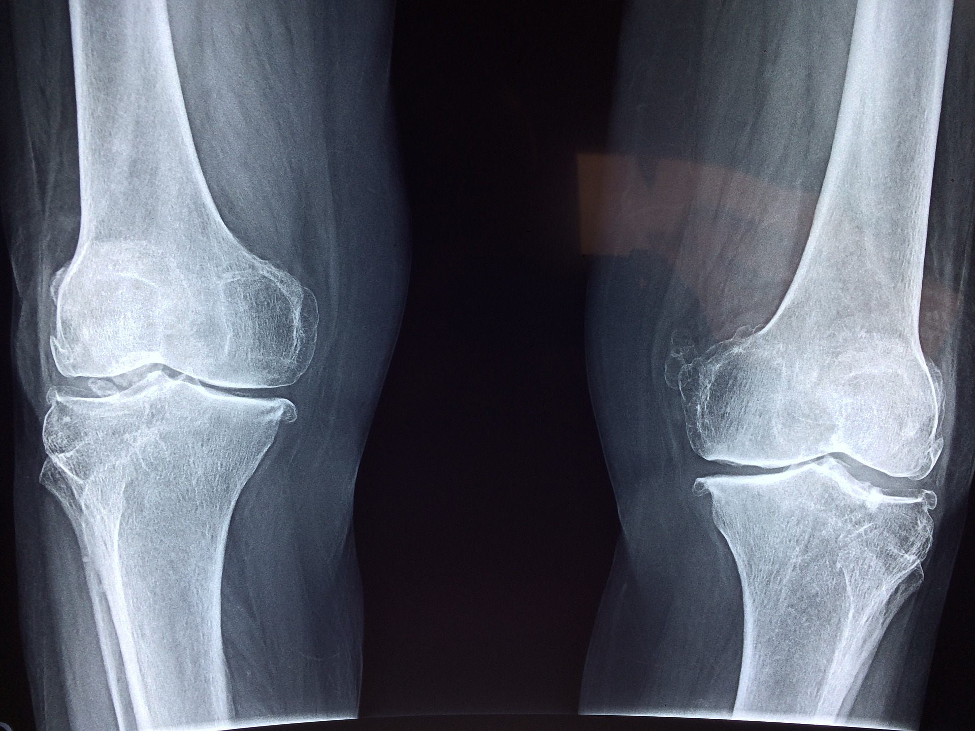 Fda Clears Zimmer Biomet S Robotic Knee Surgery System Fiercebiotech