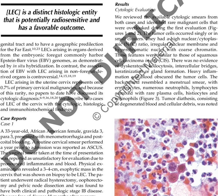 Cytology Of Lelc The Cervix Malignant Cells In A Background