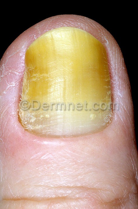 Yellow Nail Syndrome Treatment Nails
