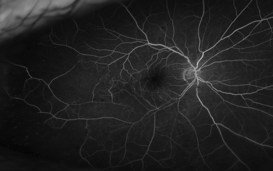 Branch Retinal Vein Occlusion Associated Consultants P C