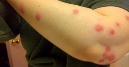 Bed Bug Bites How I Survived It And Other Gross Facts