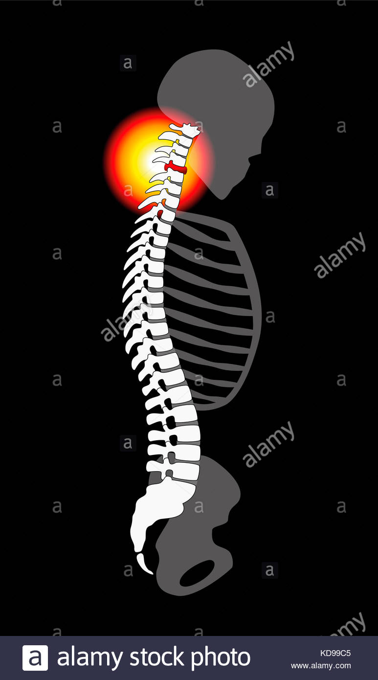Spinal Disc Prolapse Neck Pain Caused By Cervical Vertebrae