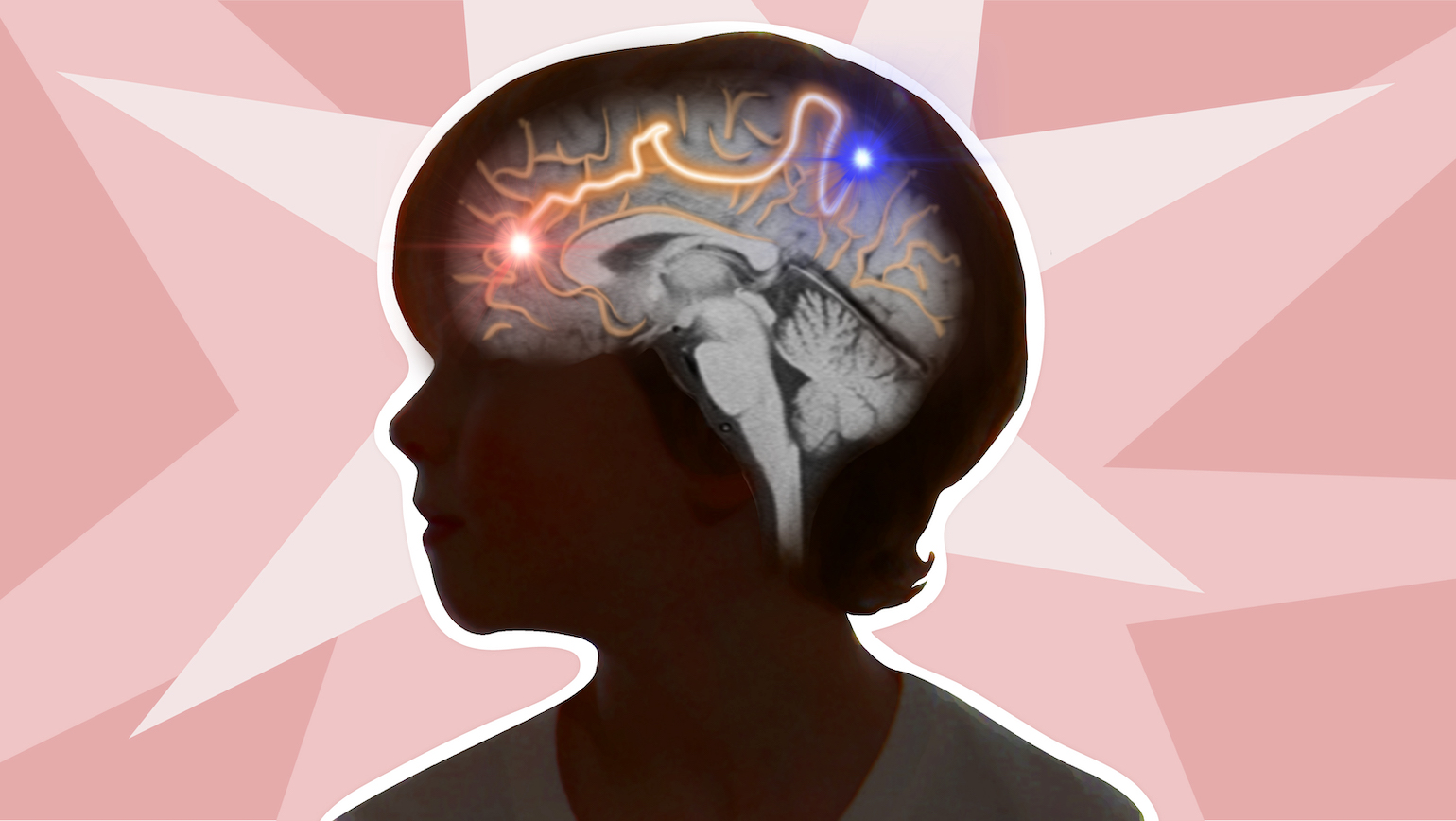 Understanding How Pediatric Epileptic Spasms Move Through The Brain Wallpaper