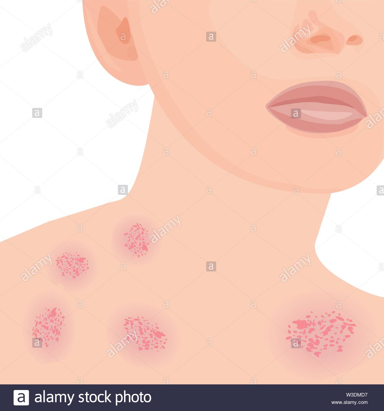 Eczema Affected A Body Dermatology Skin Disease Concept Vector