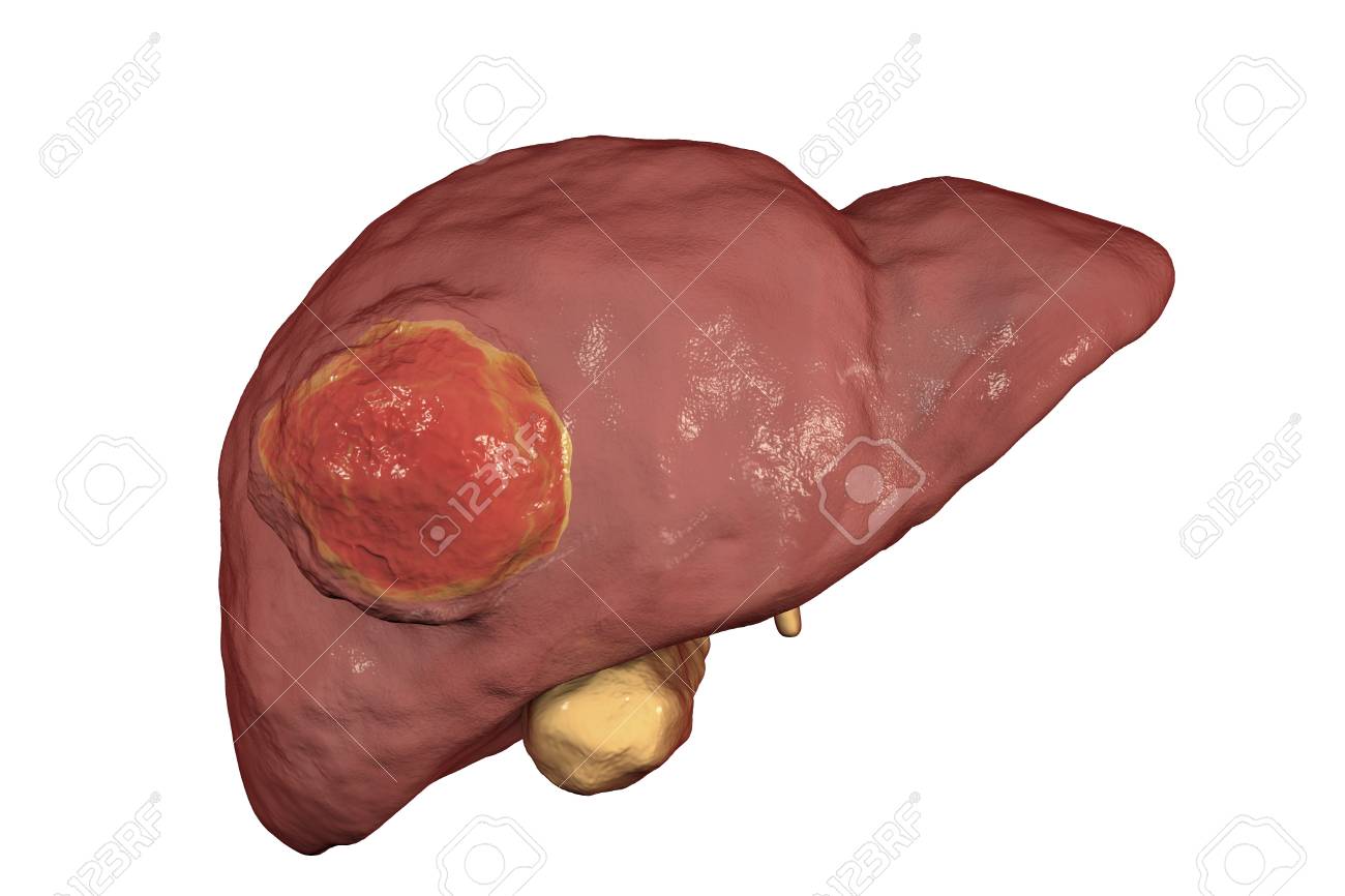 Liver Cancer 3d Illustration Showing Presence Of Tumor Inside