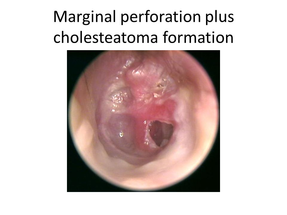 Dull Tympanic Membrane For