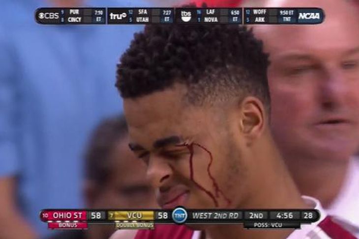Angelo Russell S Face Covered With Blood After Elbow To The