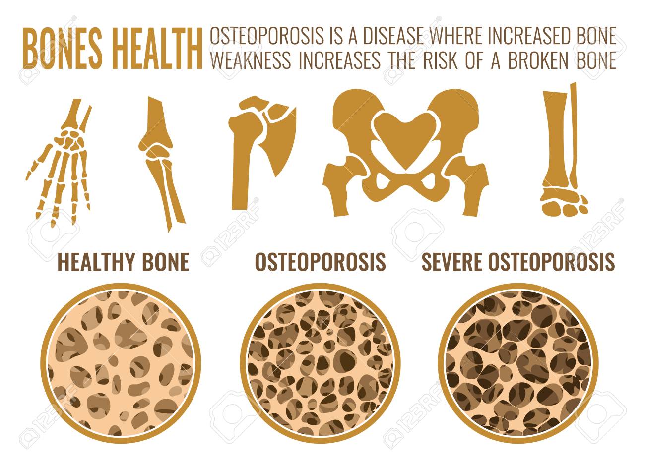 Osteoporosis Stages Image Bone And Healthy