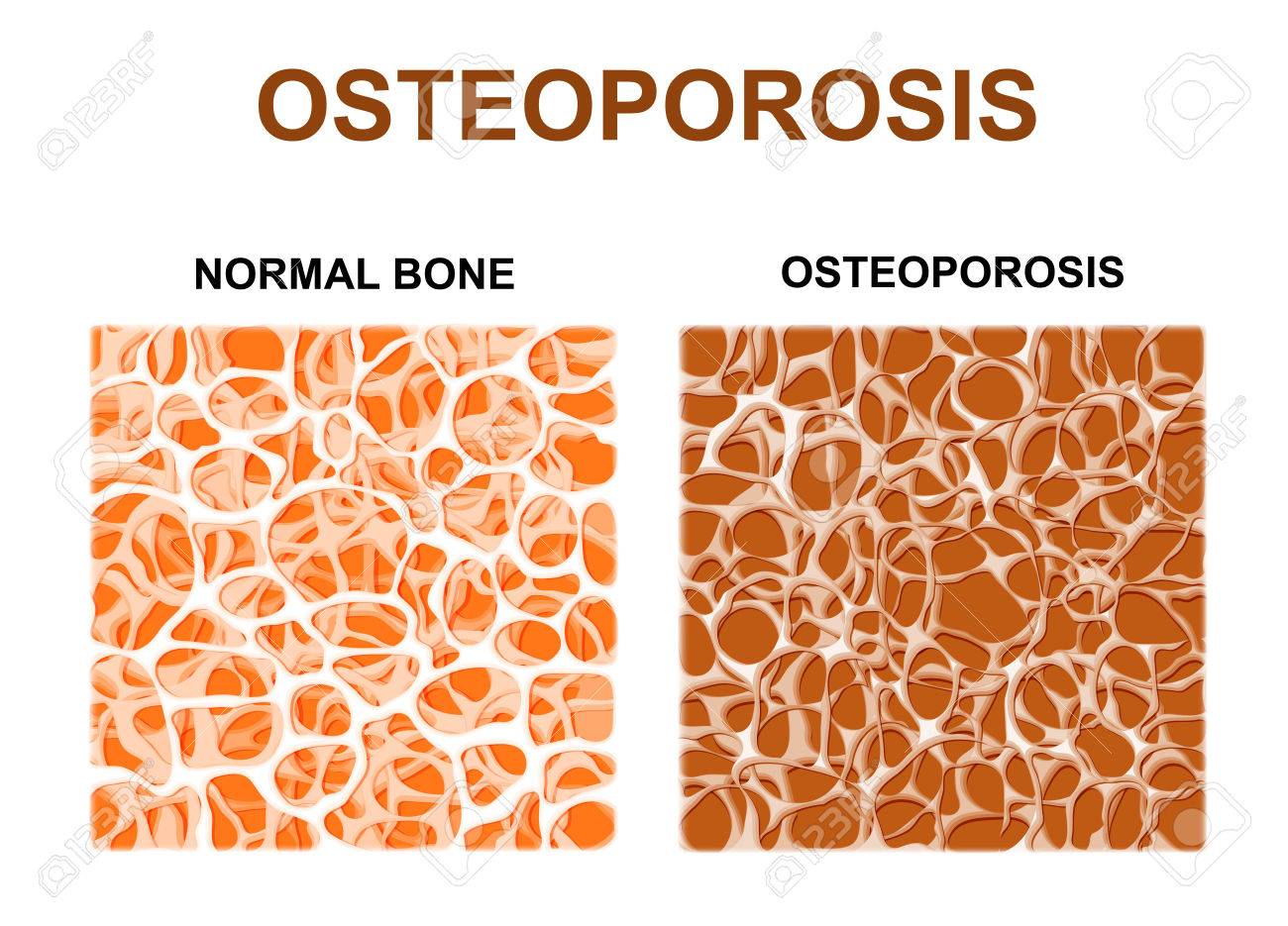 Normal Bone And With Osteoporosis Structure Vector