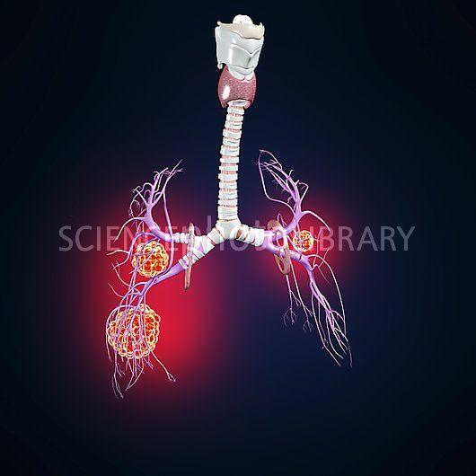 Lung Cancer Artwork Stock Image F006 Science Photo Library