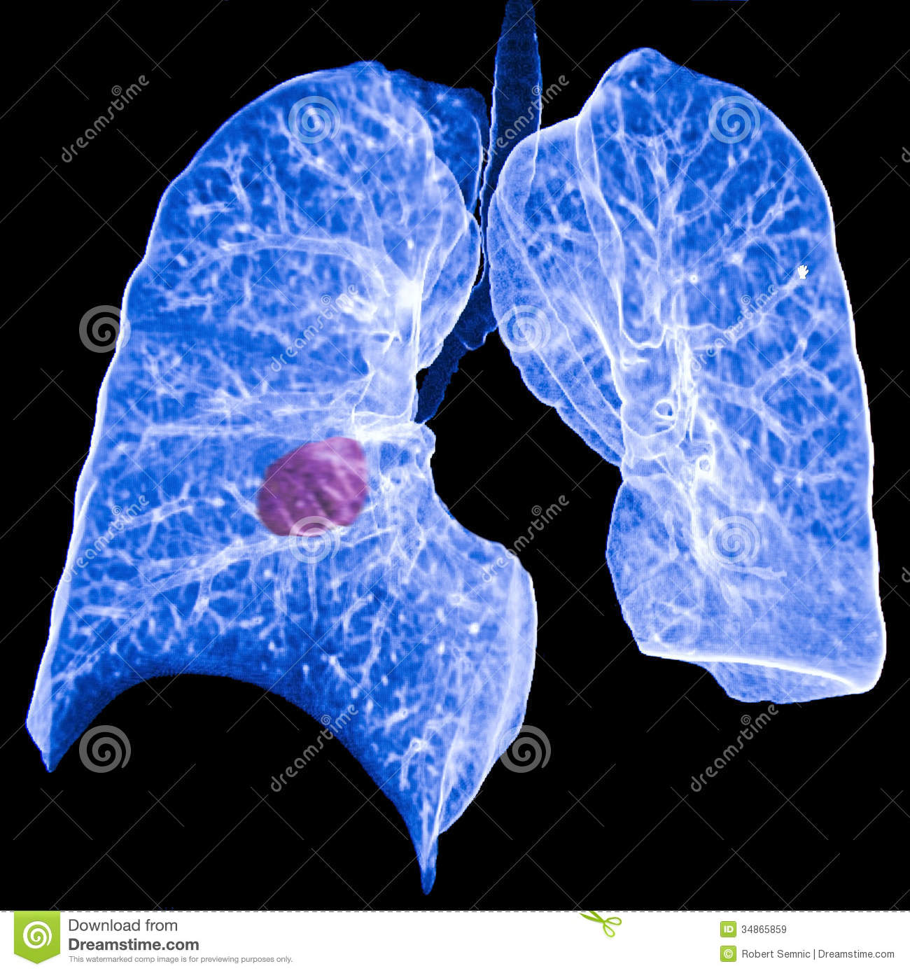 Lung Cancer Ct Royalty Stock Image Image