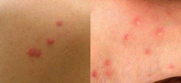 Closeups of bed bug bites left and flea bites right on human skin