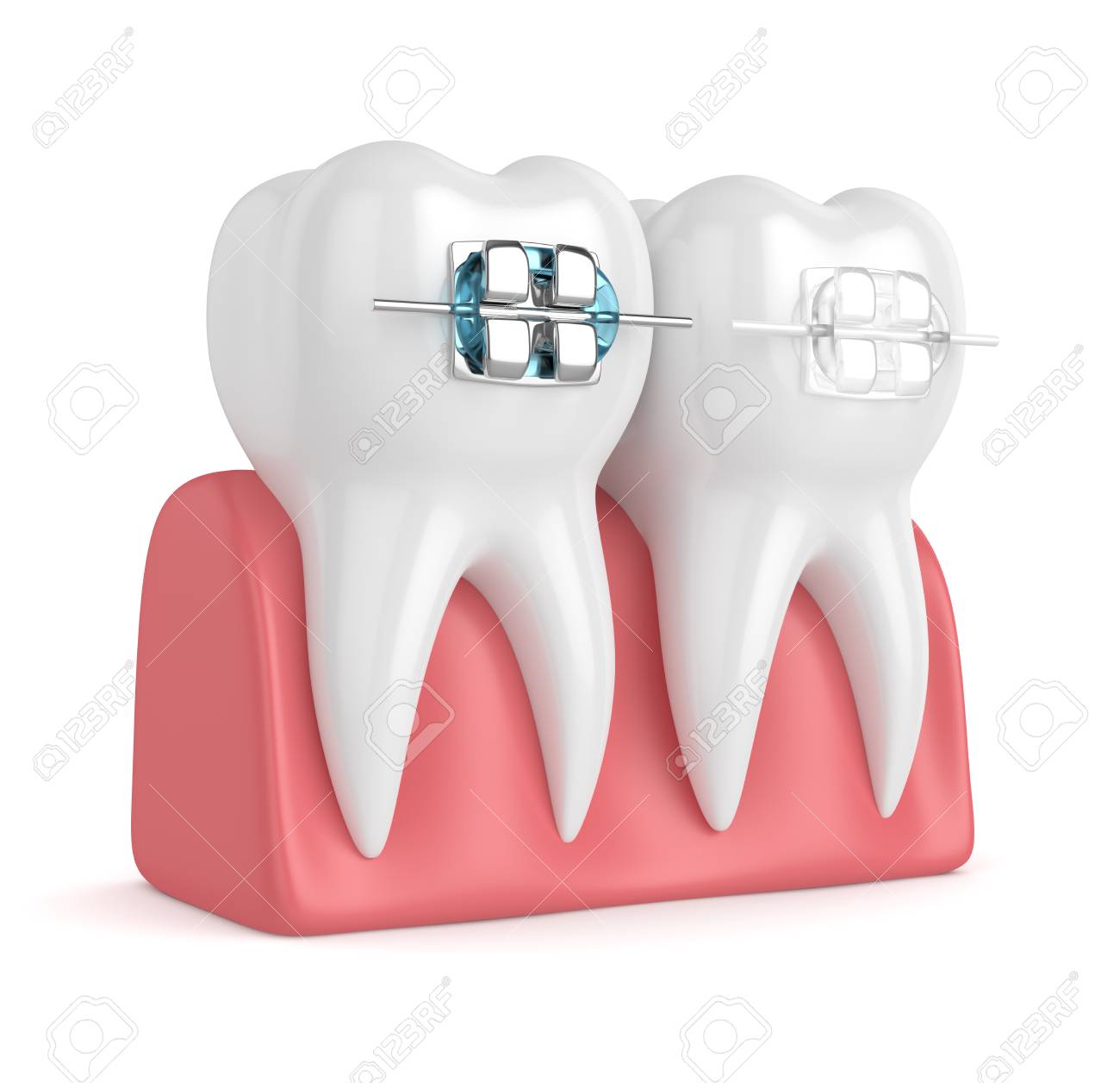 3d Render Of Teeth With Ceramic And Metal Braces In Gums Isolated