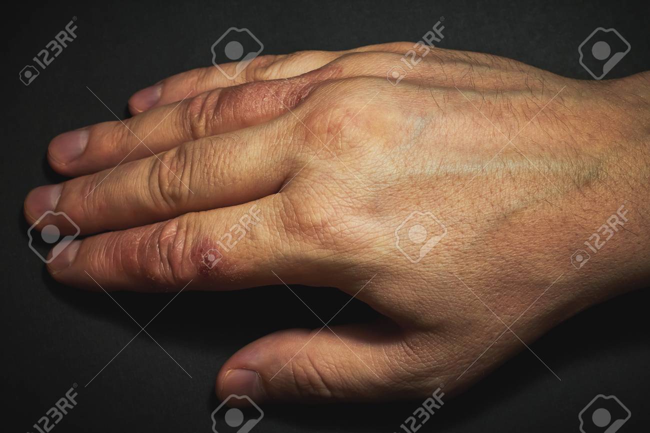 Hand Dermatitis Eczema Closed On Black Background Stock