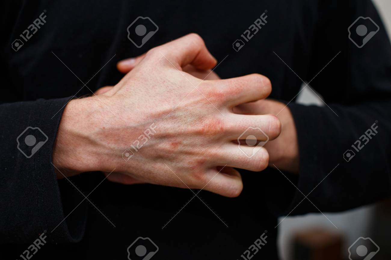 The Problem With Many People Eczema On Hand Black Background