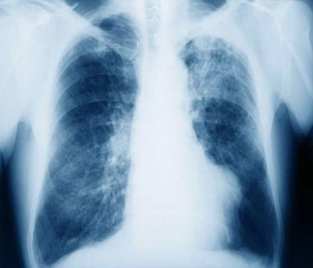 Mesothelioma Lung Cancer Desktop Background For HD Wallpaper
